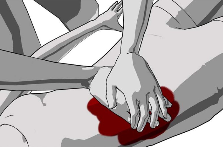 Step 3: controlling bleeding that is not on arms or legs